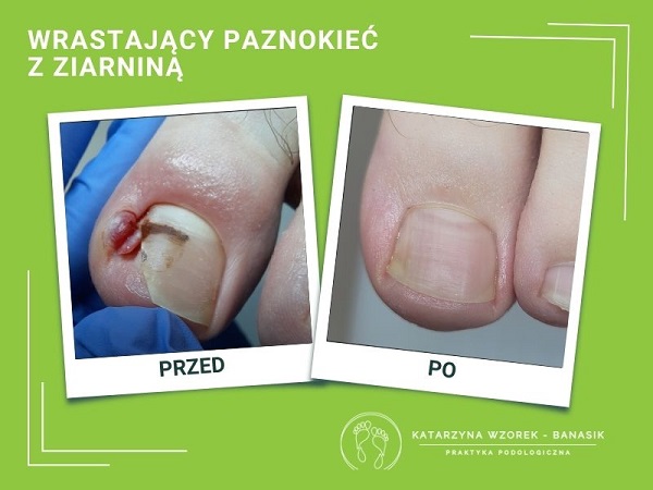wrastajacy paznokiec z&nbsp;ziarnina podolog kielce